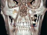 A cat scan With Titanium Plates of my face STL-0