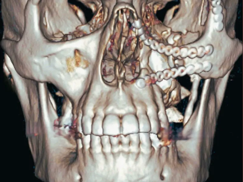A cat scan With Titanium Plates of my face STL