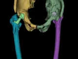 Pelvis 3D Protesis bilateral-0