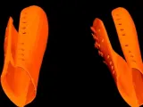 Editable Porquipine Splint-2