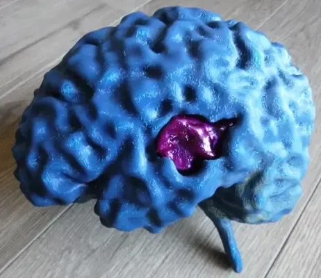 IRM du cerveau