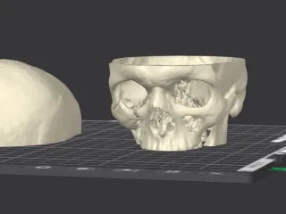 my_orbital_fracture