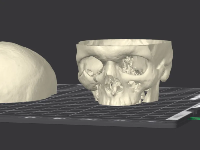 my_orbital_fracture