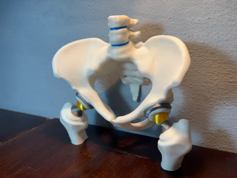 Bilateral Hip Prosthesis